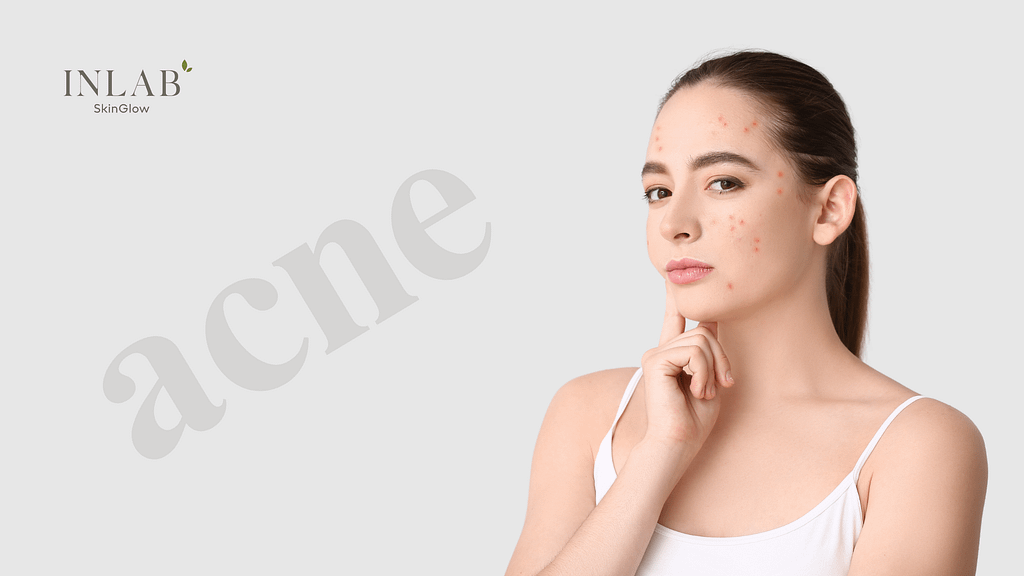 Acne Reasons, Types, Causes, and Treatments | Best Acne Solutions
